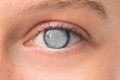 Jaskra (glaucoma) - jak są objawy jaskry?