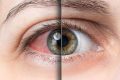 Suche oczy - jakie są objawy, leczenie i profilaktyka?